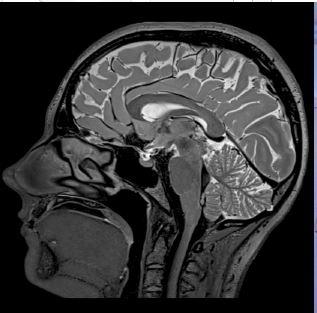 Immagine MRI